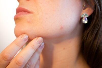 Acne and Pimples