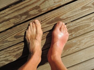 High Uric Acid and Gout