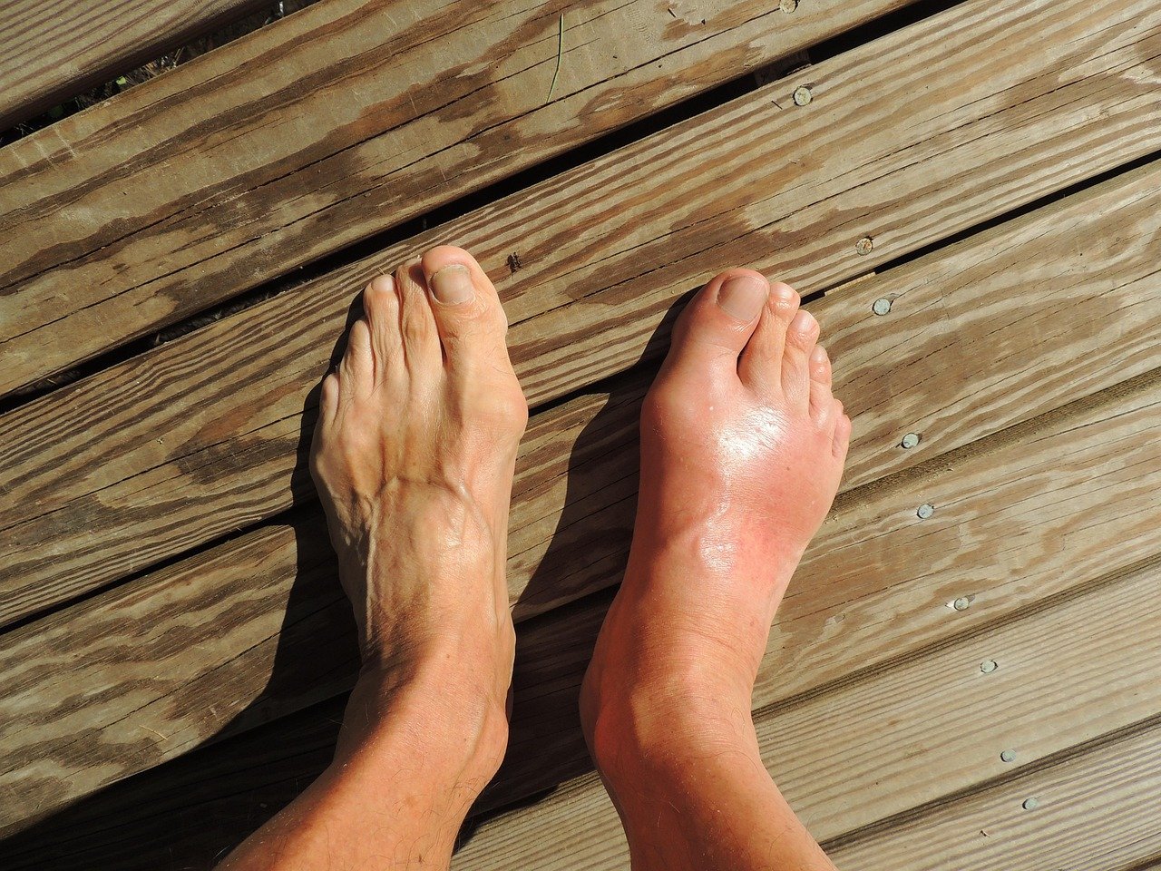 High Uric Acid and Gout - feet, gout