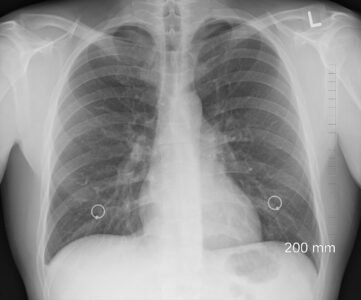 Pneumonia