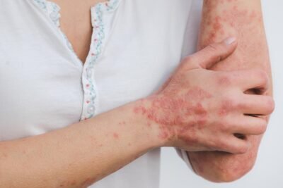 Shingles (Dad)