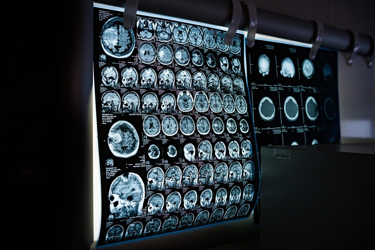 Stroke - x-ray, mri