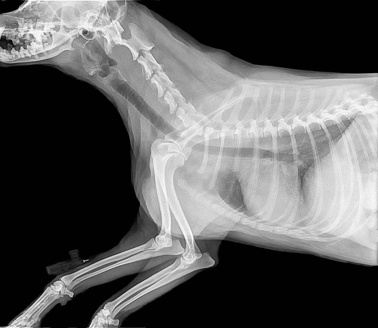 Tuberculosis (TB) - radiography, bone